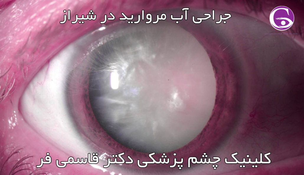 عمل جراحی آب مروارید چشم در شیراز