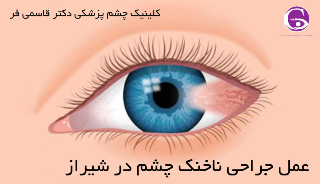 عمل جراحی ناخنک چشم در شیراز