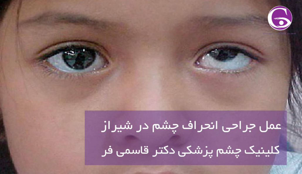 عمل جراحی انحراف چشم در شیراز