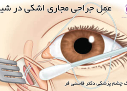 عمل جراحی مجاری اشکی در شیراز