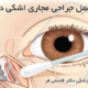 عمل جراحی مجاری اشکی در شیراز