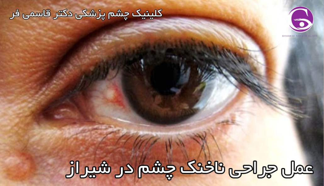 عمل جراحی ناخنک چشم در شیراز