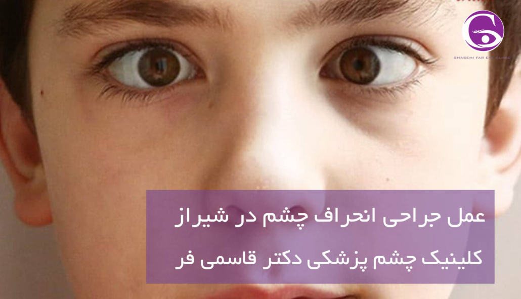 عمل جراحی انحراف چشم در شیراز