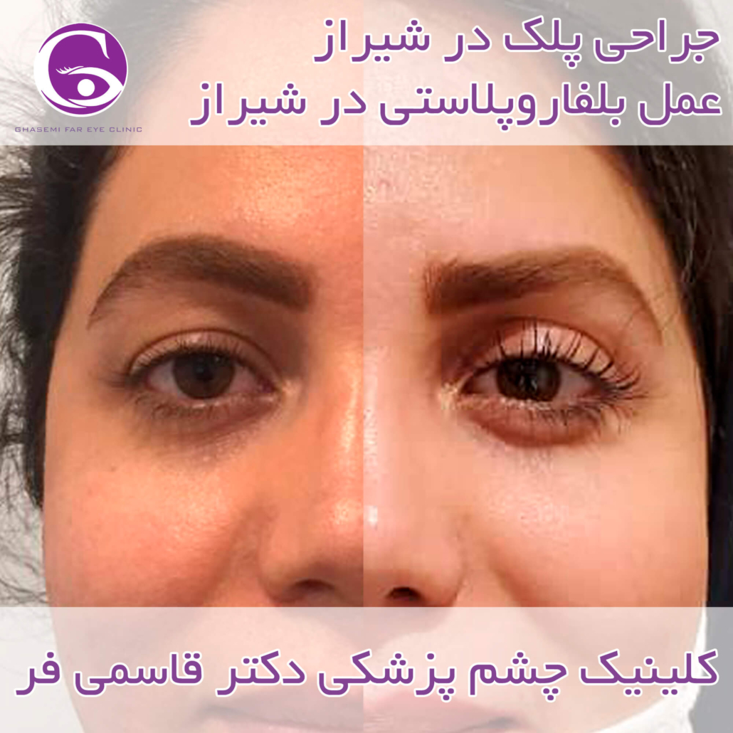 جراحی پلک در شیراز