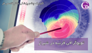 توپوگرافی قرنیه در شیراز