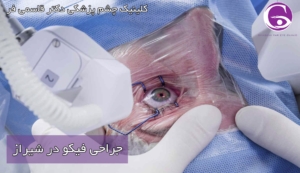 جراحی فیکو در شیراز