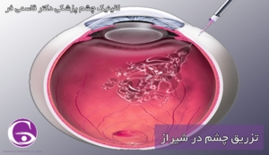 تزریق چشم در شیراز